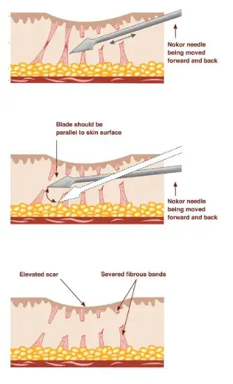 패인 흉터에 직빵이라는 치료 방법.jpg